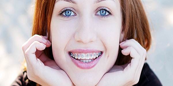 Dental Braces