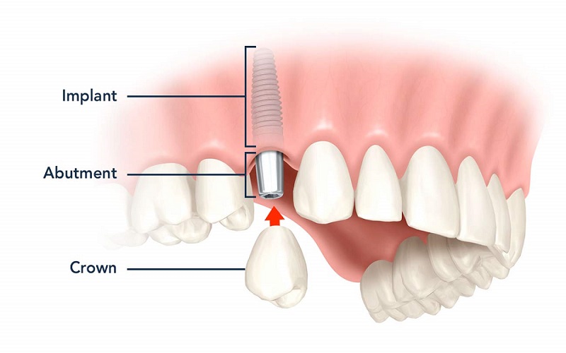 Dental Implants