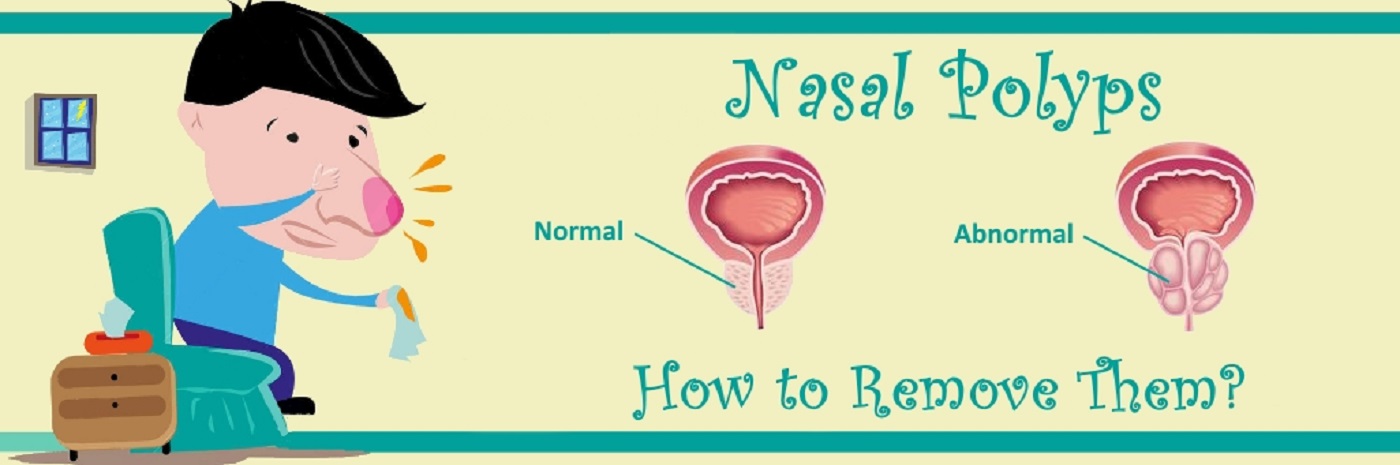 Top 6 Natural Tips To Deal With Nasal Polyps Lets Jump Today