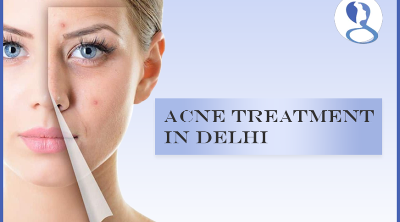 Acne Treatment in Delhi